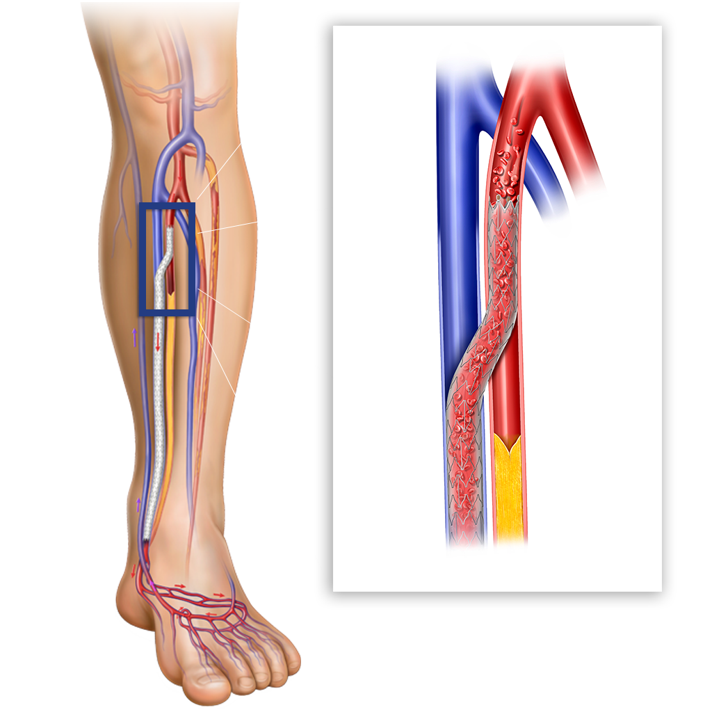 After-LimFlow-Device-Medical-CLTI-2