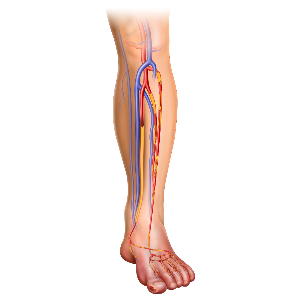 Before-LimFlow-Device-Medical-CLTI-2