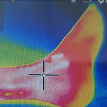 LimFlow-Clinical-Results-After-B