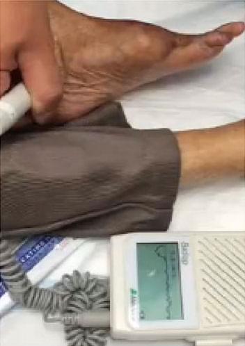 LimFlow-Clinical-Results-After-D